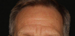Forehead Lines Before